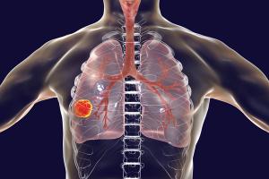 Alectinib Fails to Boost Overall Survival in ALK-Positive Non-Small Cell Lung Cancer