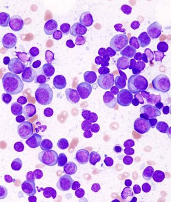 Data from the phase 3 KarMMA-3 trial support several applications for idecabtagene vicleucel in earlier use for triple-class exposed multiple myeloma in the United States, Europe, and Japan.