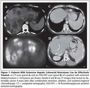 The Evolution of Liver-Directed Treatments for Hepatic Colorectal Metastases 