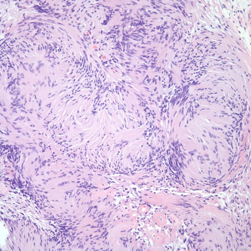 Patient Presents With Neck Lesion