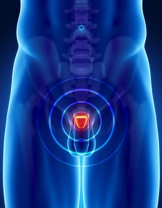 prostate cancer