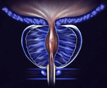 Metastasis-Directed Therapy Plus Intermittent Hormone Therapy Improves PFS in Oligometastatic Prostate Cancer