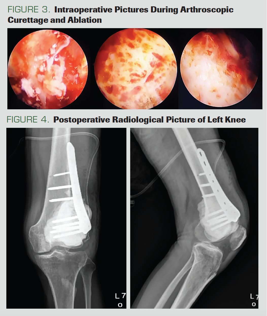 An Arthroscopic Approach for the Intralesional Curettage of