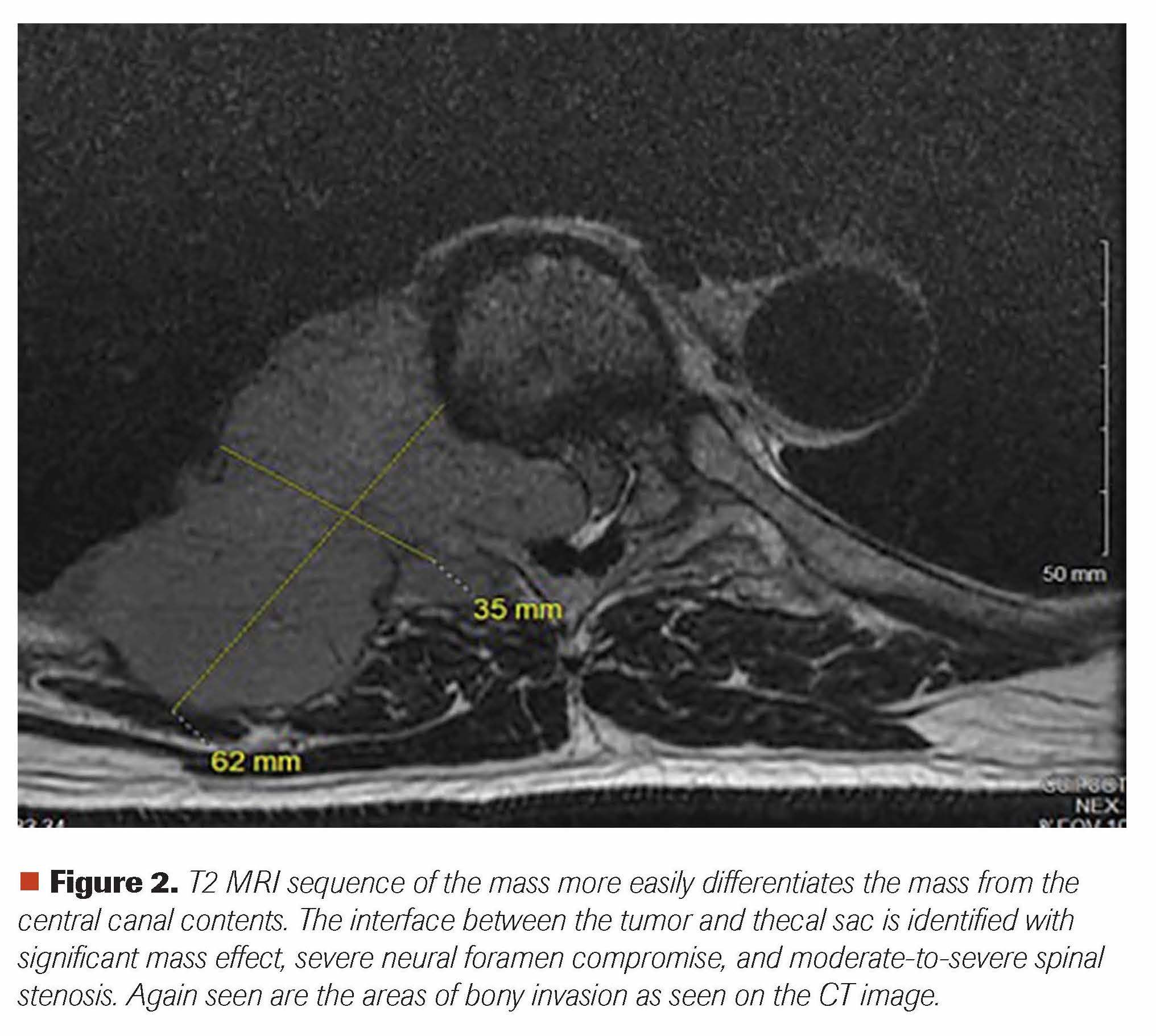 Figure 2. T2 MRI sequence of the mass more easily differentiates the mass from the central canal contents. The interface between the tumor and thecal sac is identified with significant mass effect, severe neural foramen compromise, and moderate-to-severe spinal stenosis. Again seen are the areas of bony invasion as seen on the CT image.