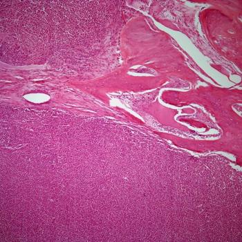 When teclistamab was evaluated in a real-world setting, investigators determined that efficacy was similar between that and the phase 2 MajesTec-1 trial for patients with relapsed/refractory multiple myeloma. 