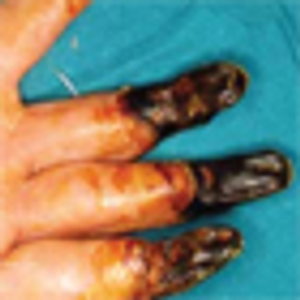 Cryoglobulinemic Disease