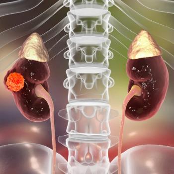 Neoadjuvant Immunotherapy May Help Improve Disease Control in RCC