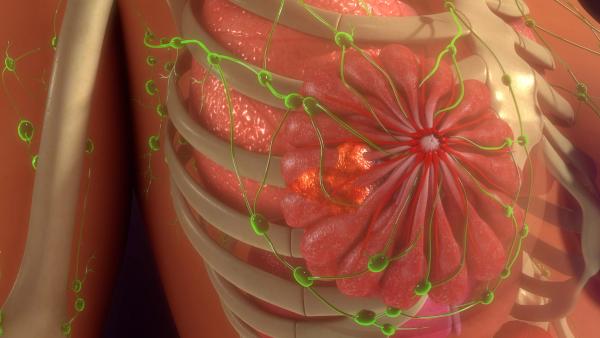 Subgroup data from the phase 3 DESTINY-Breast05 trial further characterize the clinical benefit of T-DXd over T-DM1 in this breast cancer population. 