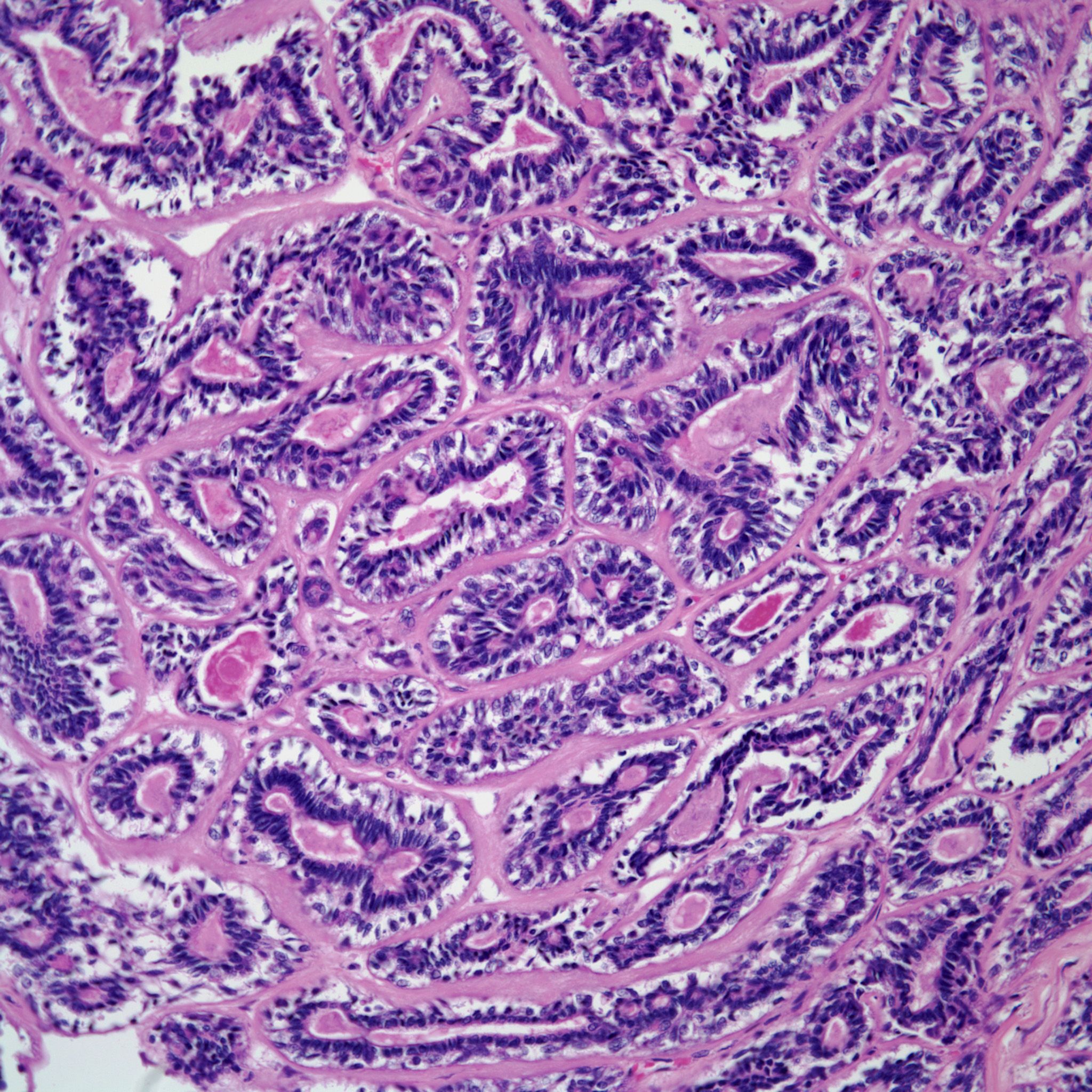 43 Year Old Woman With Dyspnea Wheezing And Shortness Of Breath 43-year-old-woman-with-dyspnea-wheezing-and-shortness-of-breath
