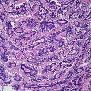 43-Year-Old Woman With Dyspnea, Wheezing, and Shortness of Breath