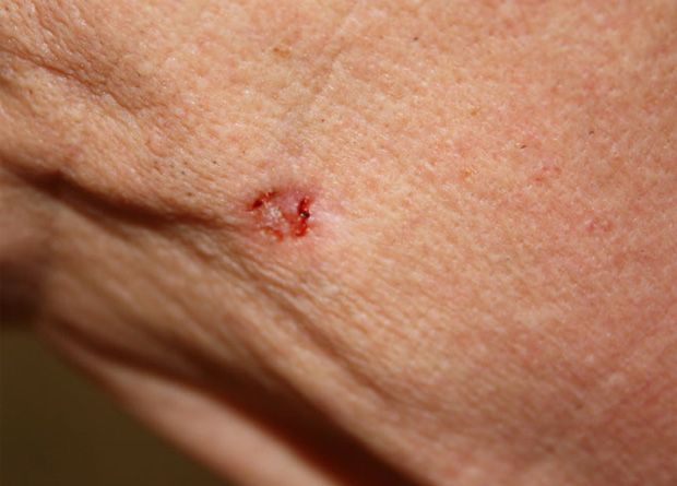 Basal cell carcinoma lesion