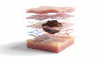 Layered Skin Cross-Section With Melanoma Tumor: © MIQ - stock.adobe.com