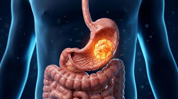 Evorpacept Plus TRP Improves ORR in Pretreated HER2+ Gastric Cancer: © BrilliantPixels - stock.adobe.com