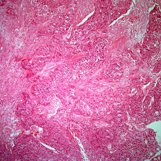 Findings from the phase 3 SWOG S1011 trial indicate no significant differences between extended lymphadenectomy vs standard lymphadenectomy in terms of disease-free survival in patients with muscle-invasive breast cancer.