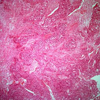 Findings from the phase 3 SWOG S1011 trial indicate no significant differences between extended lymphadenectomy vs standard lymphadenectomy in terms of disease-free survival in patients with muscle-invasive breast cancer.