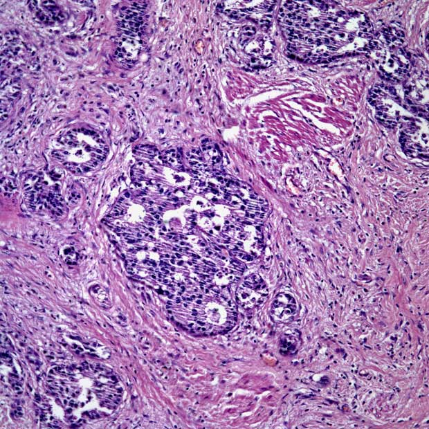 Efficacy and safety data from the phase 2b SUNRISE-1 trial support the ongoing evaluations of TAR-200 as a treatment for patients with BCG-unresponsive high-risk non–muscle-invasive bladder cancer.