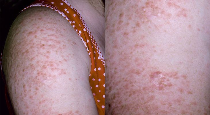 pinpoint red dots on skin colon cancer