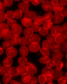 Data from the phase 1/2 CADENZA trial support pivekimab sunirine as a potential standard treatment for this rare blood cancer population.
