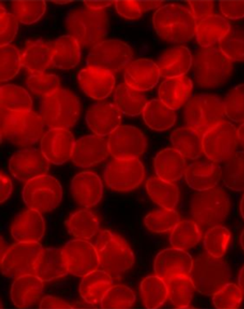 Data from the phase 1/2 CADENZA trial support pivekimab sunirine as a potential standard treatment for this rare blood cancer population.