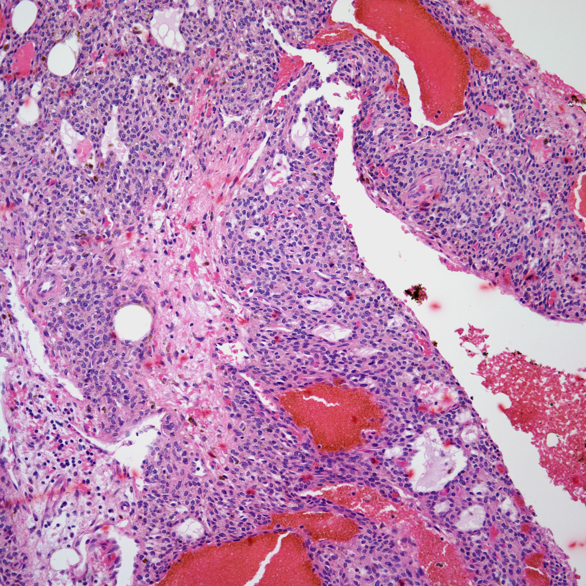 A 48-Year-Old Man With A Soft Tissue Tumor | Cancer Network