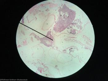 Gestational Trophoblastic Neoplasia