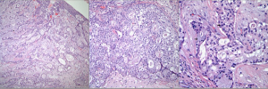 An 18-Year-Old Man Presents With Cough and Dyspnea, Radiographic Imaging Reveals a Tumor