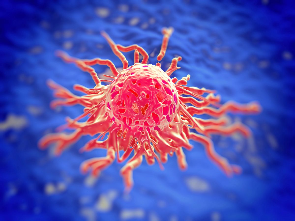 Experts discussed diagnosing and treating epithelioid sarcoma, emphasizing the importance of clinical history and the role of multiple multidisciplinary clinicians in care.