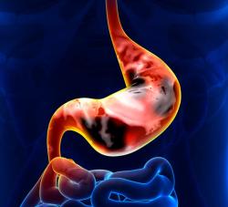 Fruquintinib/Paclitaxel Meets PFS End Point in Second-Line Gastric Cancer Trial