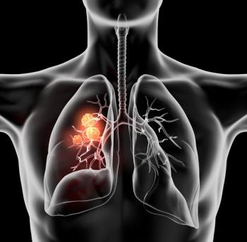 Data from a phase 1 trial highlight a clinically acceptable safety profile for BI 764532 in patients with extensive-stage small cell lung cancer and extrapulmonary neuroendocrine carcinomas.