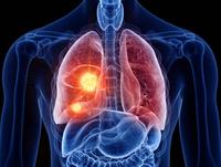 The safety profile of durvalumab after radiotherapy was consistent with durvalumab after chemoradiotherapy among those with unresectable stage III NSCLC.