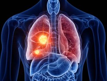 The safety profile of durvalumab after radiotherapy was consistent with durvalumab after chemoradiotherapy among those with unresectable stage III NSCLC.