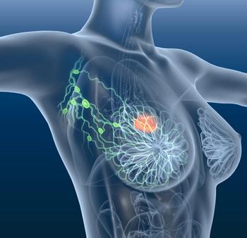 Data collected from 1400 global laboratories indicate that standard immunohistochemistry testing may not be the most effective method to identify patients with breast cancer with HER2-low disease.