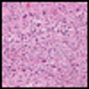 ESMO: New Agent, Aldoxorubicin (INNO-206), Shows Activity in Soft-Tissue Sarcoma