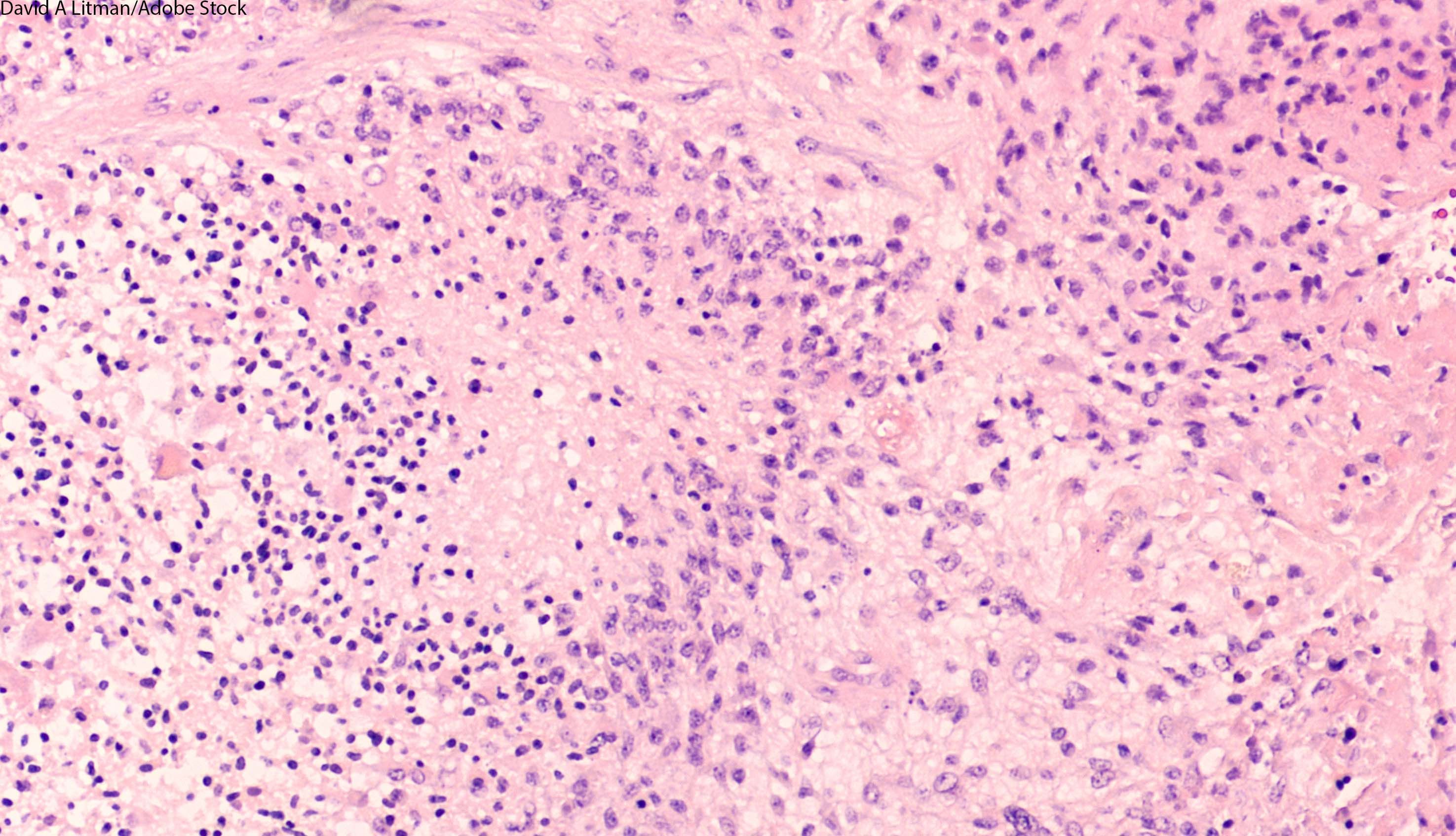 ERAS-801, which now has FDA fast track designation for glioblastoma with EGFR alterations, is currently under investigation as a monotherapy in the phase 1 THUNDERBBOLT-1 trial.