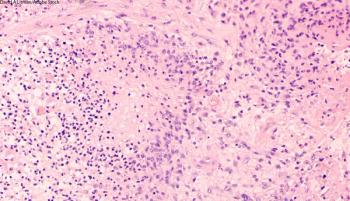 ERAS-801, which now has FDA fast track designation for glioblastoma with EGFR alterations, is currently under investigation as a monotherapy in the phase 1 THUNDERBBOLT-1 trial.