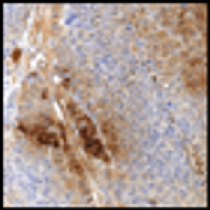 The Use of Serum hCG as a Marker of Tumor Progression and of the Response of Metastatic Urothelial Cancer to Systemic Chemotherapy