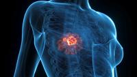 Comprehensive Anatomical Render Of Breast Cancer In A Human Female: © Sebastian Kaulitzki - stock.adobe.com