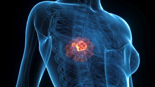 Comprehensive Anatomical Render Of Breast Cancer In A Human Female: © Sebastian Kaulitzki - stock.adobe.com