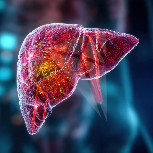 ctDNA Assay Shows High Specificity for Post-Transplant Liver Cancer Recurrence: © zhi - stock.adobe.com