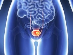 Pembrolizumab Remains Effective for Years in a Bladder Cancer Subset