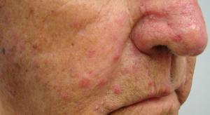 Patient With Multiple Brain Metastases