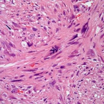 Patients under the age of 3 with neuroblastoma experienced no significant negative impact on survival when their disease was reclassified from high-risk to intermediate-risk and their therapy was thusly reduced.