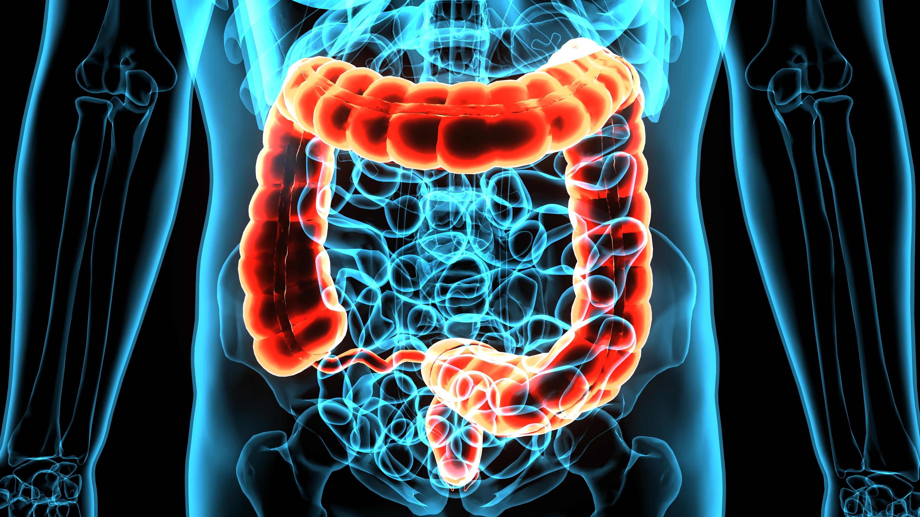Phase 3 BATTMAN Trial in Colon Cancer Discontinued: © PIC4U - stock.adobe.com