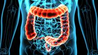 Phase 3 BATTMAN Trial in Colon Cancer Discontinued: © PIC4U - stock.adobe.com