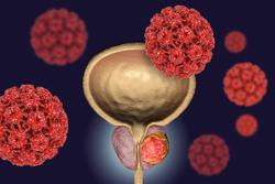 Atezolizumab No Longer Available in US for a Certain Type of Bladder Cancer