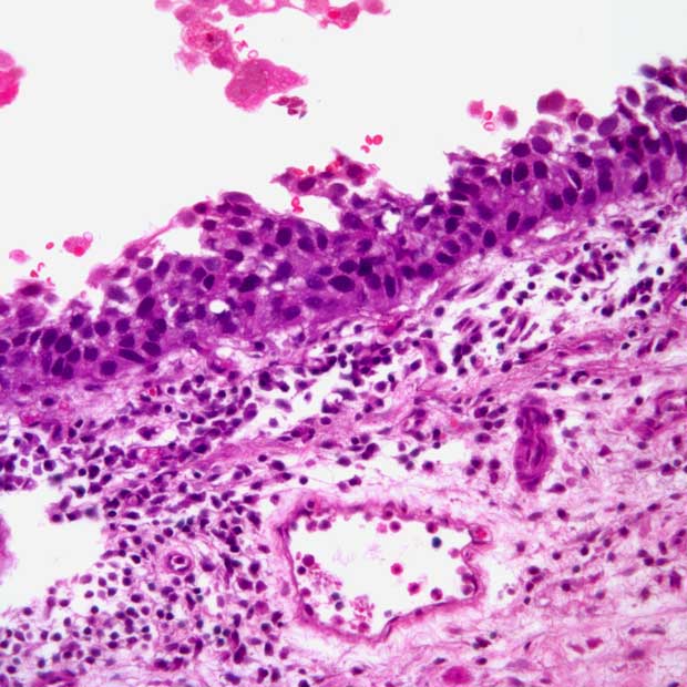 Supporting data for the EMA comes from the phase 3 EV-302 trial, which assessed the efficacy of enfortumab vedotin in combination with pembrolizumab compared with chemotherapy.