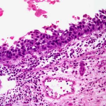 Supporting data for the EMA comes from the phase 3 EV-302 trial, which assessed the efficacy of enfortumab vedotin in combination with pembrolizumab compared with chemotherapy. 
