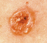 Updated results from the phase 1 CK-301-101 trial support the updated label for cosibelimab in this cutaneous squamous cell carcinoma population.