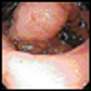 Granulocytic Sarcoma in a Patient With Myelodysplastic Syndrome