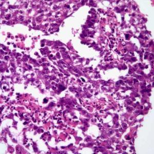 Investigators report no differences in progression-free survival among patients with nonseminomatous testicular cancer who received surveillance or adjuvant chemotherapy in a cohort study.